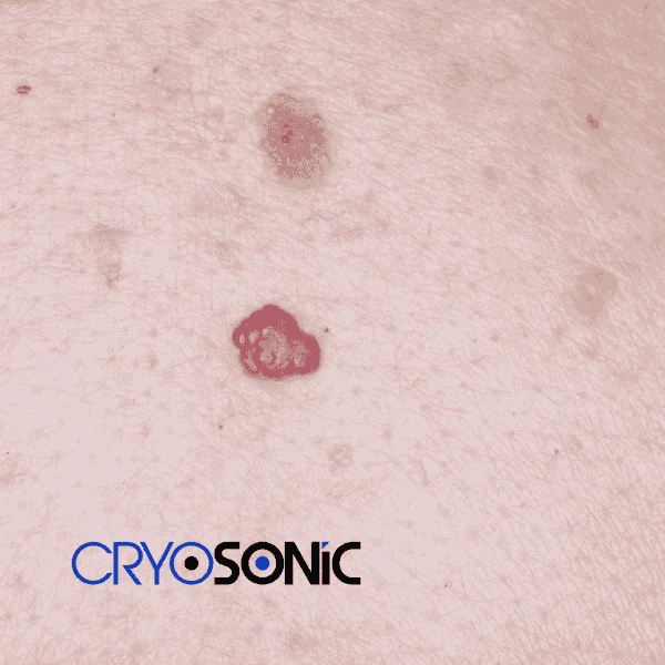 Looking for pain free cherry angioma removal treatment Earl Shilton? Call our team today! Earl Shilton
