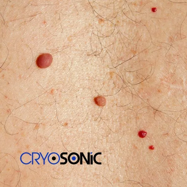get cherry angioma removal treatment today! Earl Shilton