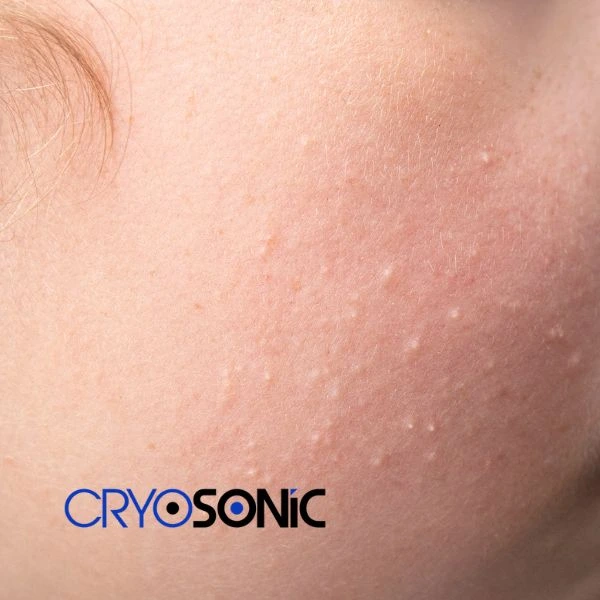 Are you looking for milia removal treatment? Contact our team today Earl Shilton
