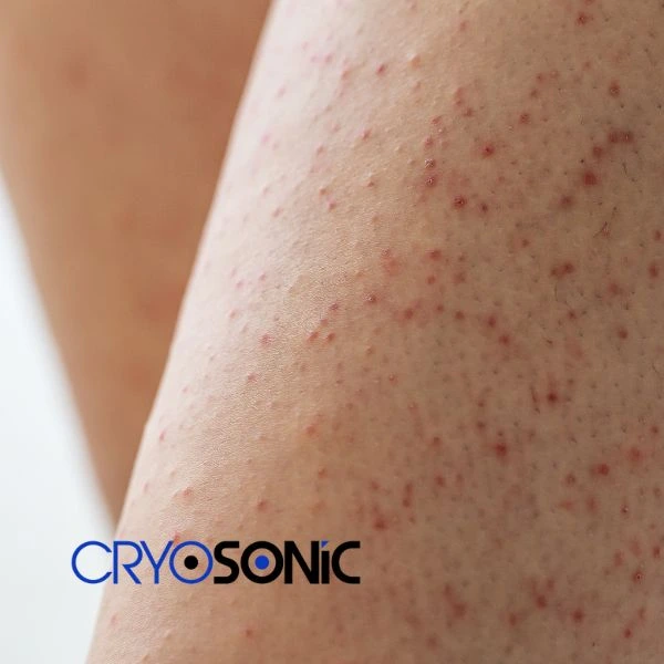 Looking for Seborrhoeic Keratosis removal Earl Shilton treatment? Call our consultants today in Earl Shilton