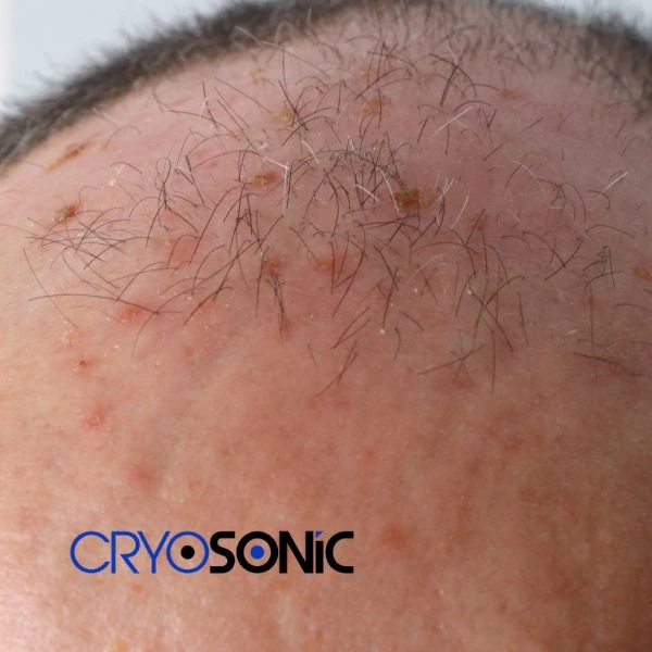 Access Seborrhoeic Keratosis removal from the comfort of your own home! Call us today in Earl Shilton