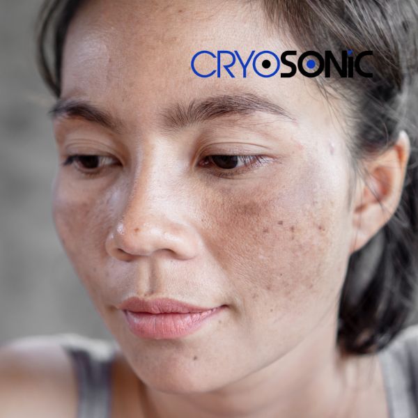 Ready to start age spots removal? Contact our team today in Earl Shilton