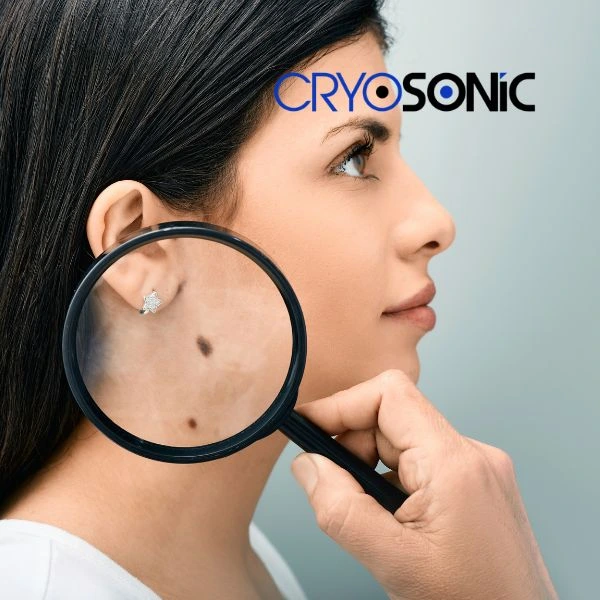 Do you want to learn more about benign moles removal treatment? Call our team today Earl Shilton