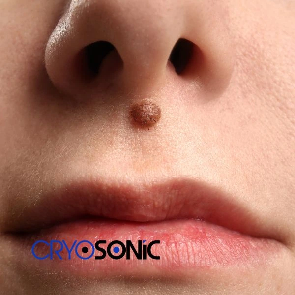 Start your benign moles removal treatment today Earl Shilton