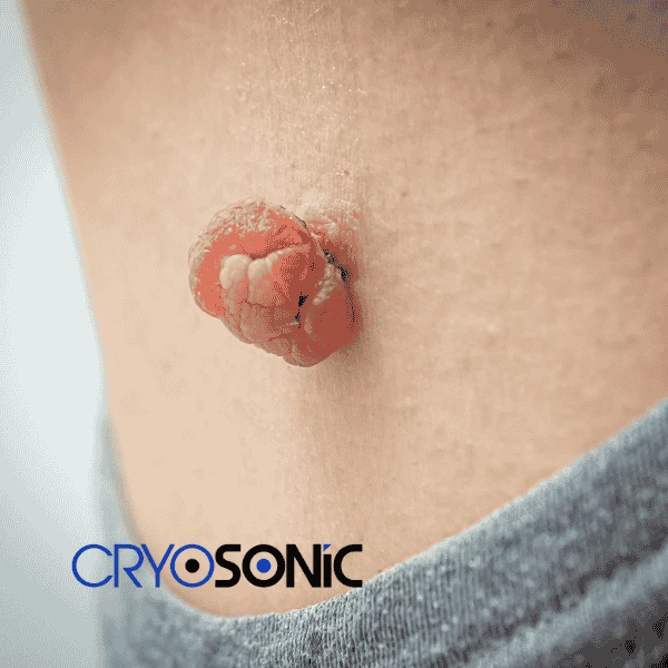 Book your skin tags removal Earl Shilton from comfort of your own home! Earl Shilton