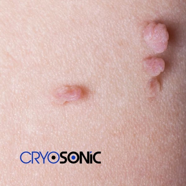 Are you looking for fast effect skin tag removal Earl Shilton? Book in NOW! Earl Shilton