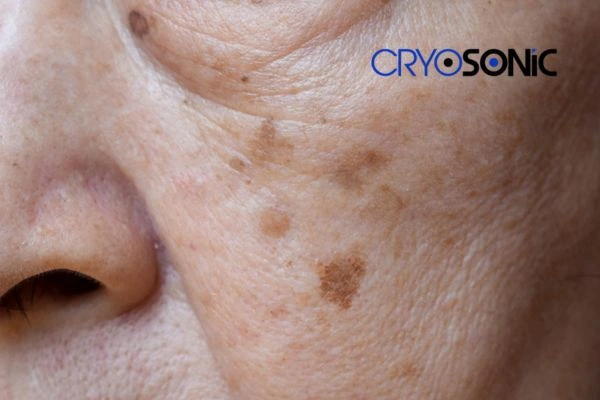 Protecting Your Skin from Sun Damage and Age Spots Earl Shilton