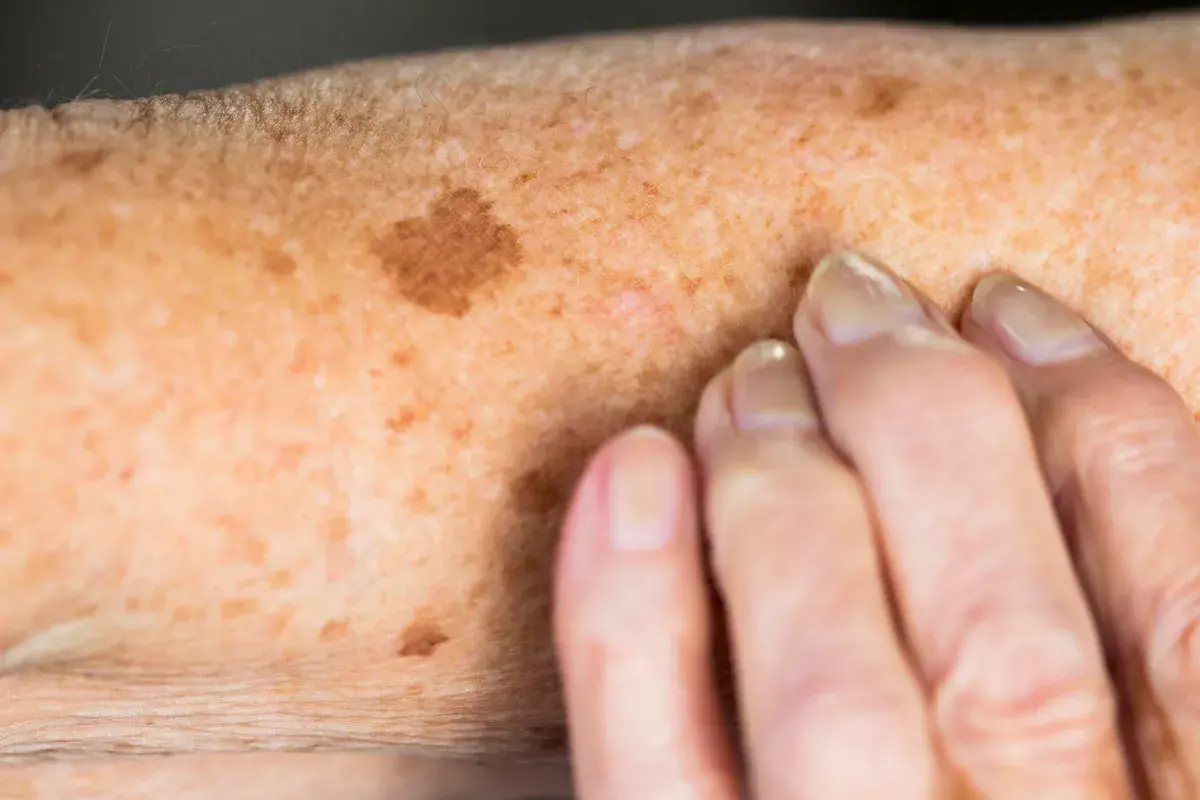 FAQs for Protecting Your Skin from Sun Damage Earl Shilton