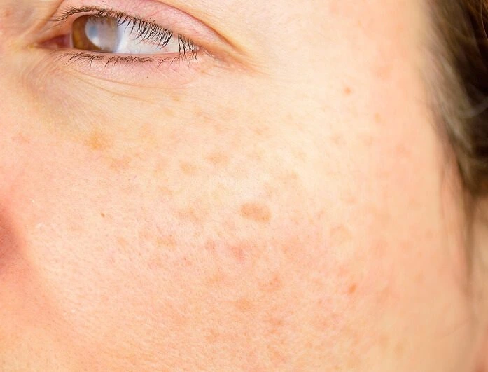 How Can Sun Protection Support Age Spot Treatments Earl Shilton