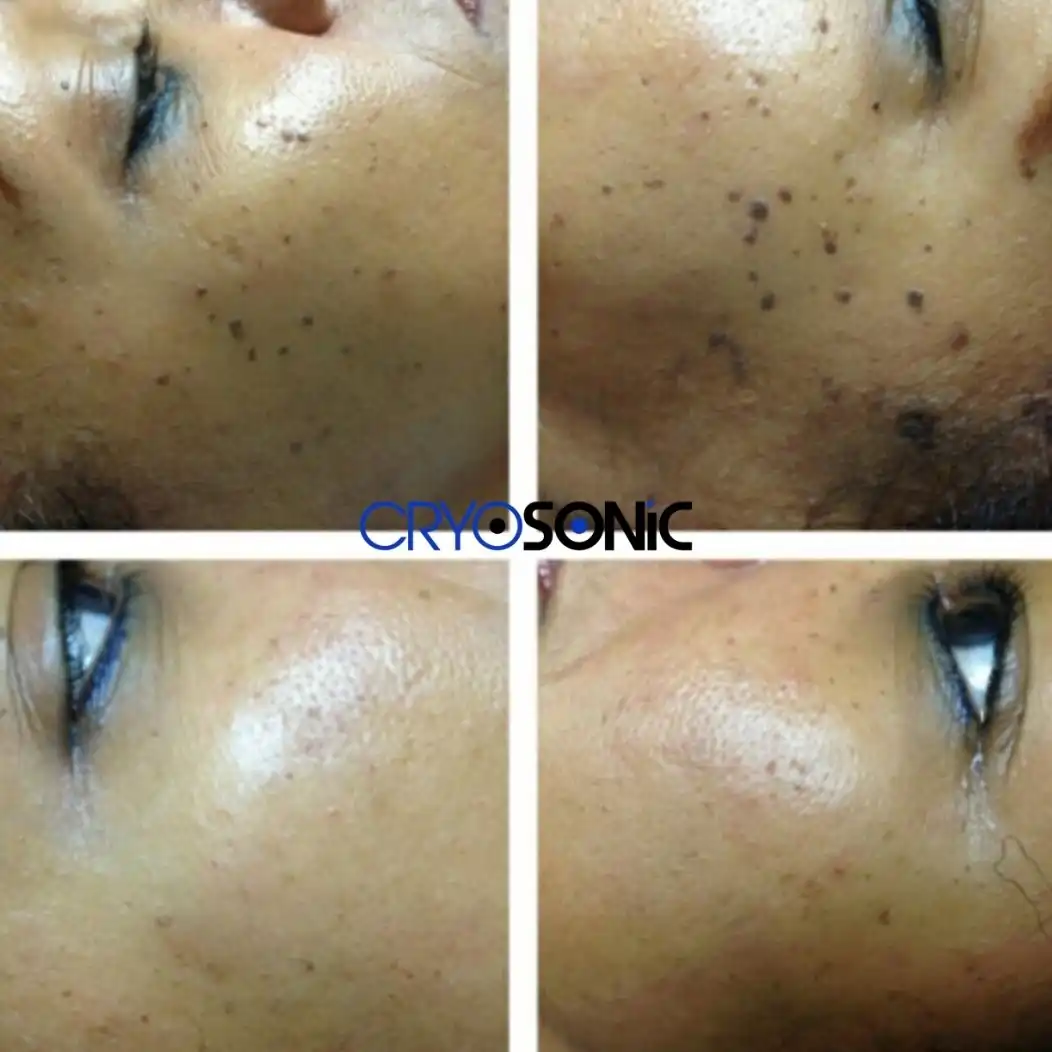 Cryotherapy for Dark Skin: Pigmentation Risks and Specific Protocols Earl Shilton