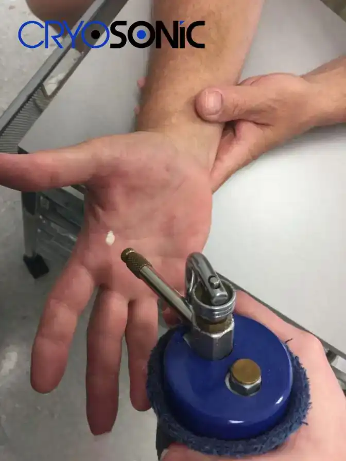 Temperature Differences: OTC vs Medical-Grade Cryotherapy Earl Shilton